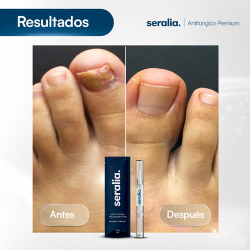 Lápiz Antihongos | Seralia