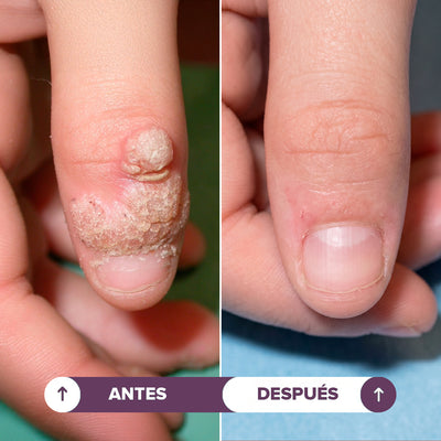 Seralia | Lápiz Antiverrugas