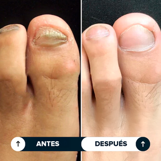 Seralia | Lápiz Antihongos