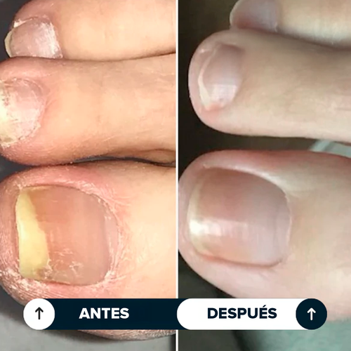 Seralia | Lápiz Antihongos