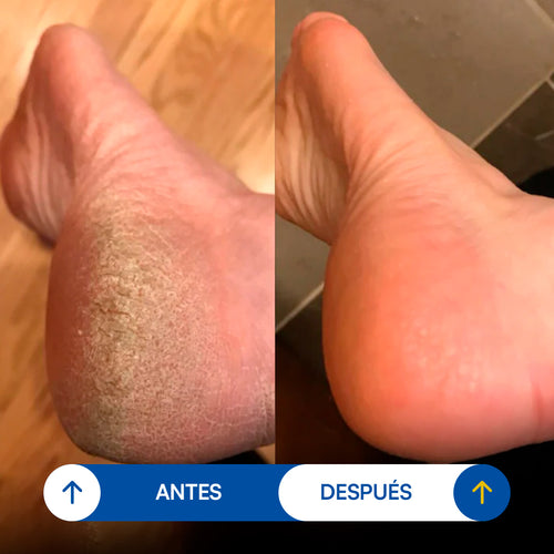 Removedor de Callos Seralia
