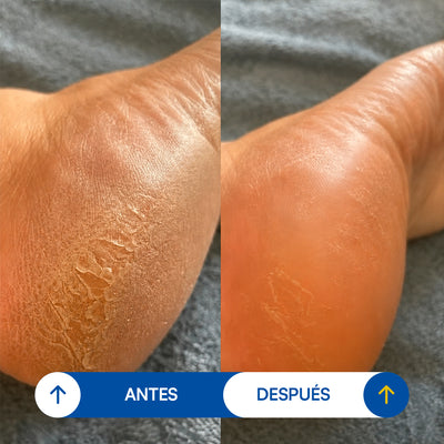 Removedor de Callos Seralia
