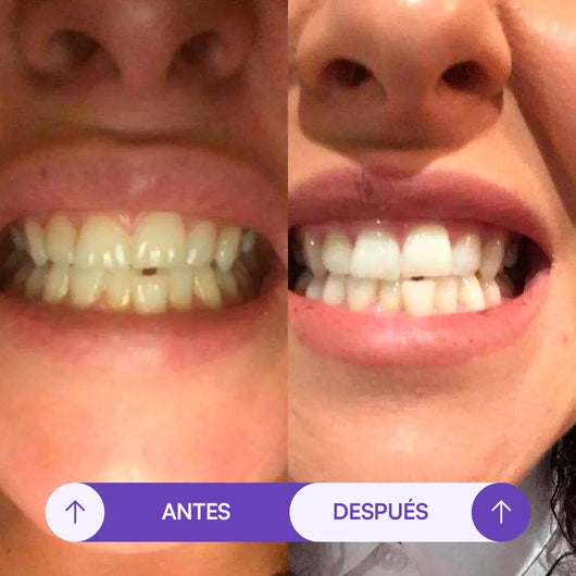 Tiras Blanqueadoras Seralia