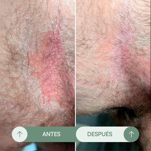 Crema para Rozaduras en Pliegues - Seralia