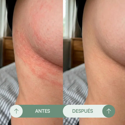 Crema para Rozaduras en Pliegues - Seralia