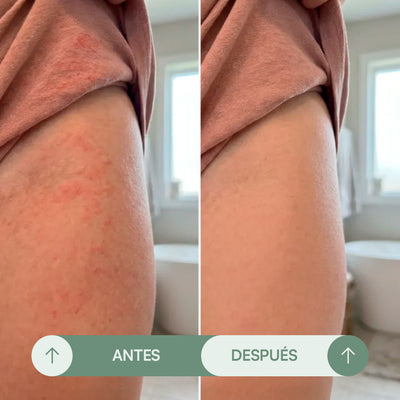 Crema para Rozaduras en Pliegues - Seralia