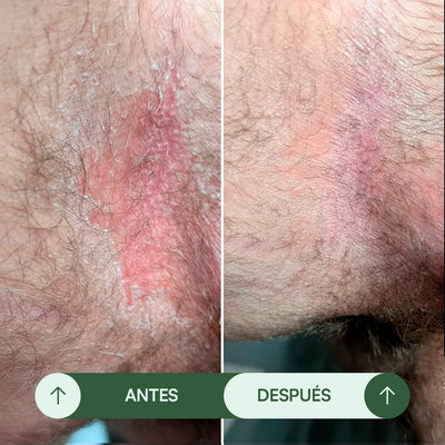 Jabón Antifúngico Seralia