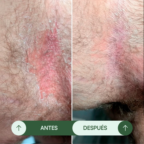 Jabón Antifúngico Seralia