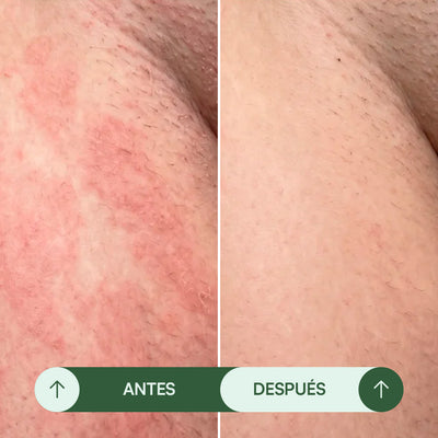 Jabón Antifúngico Seralia