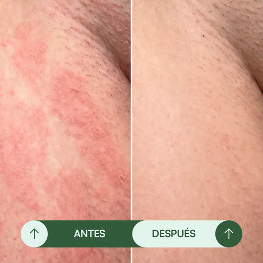 Jabón Antifúngico Seralia